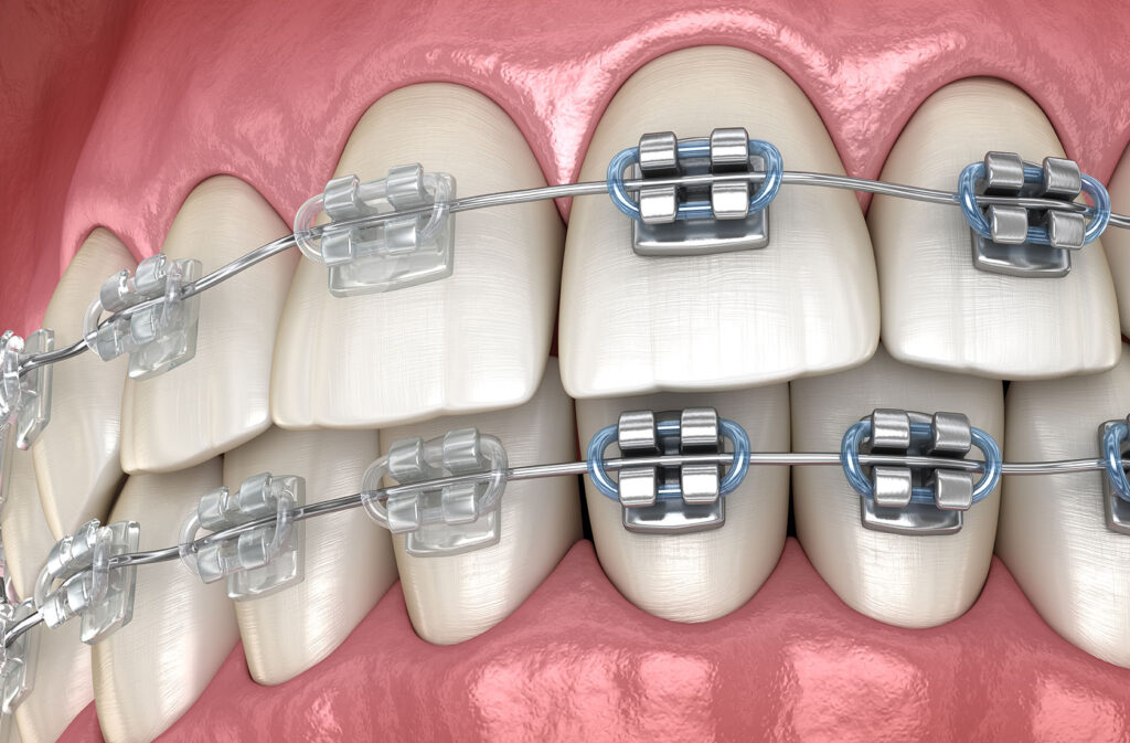 Metal braces vs clear braces