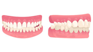 graphic showing crossbite