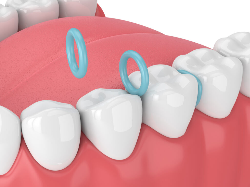 orthodontic spacers graphic