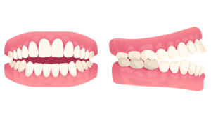 graphic showing open bite