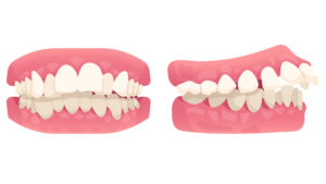 graphic showing overjet