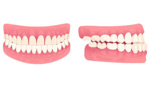 graphic showing underbite